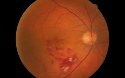 Aflibercept (Eylea®) y el implante intravítreo de dexametasona (Ozurdex®) permiten reducir el número de inyecciones intravítreas en el tratamiento de la retinopatía diabética y la oclusión venosa retiniana.