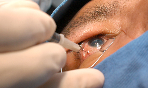 Nuevos avances en la cirugía de glaucoma