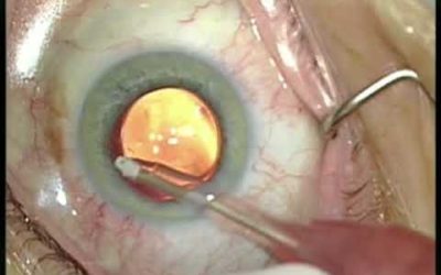 Microimplante para glaucoma: un gran avance