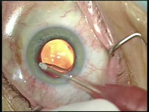 Microimplante para glaucoma: un gran avance