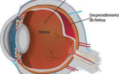 Desprendimiento de retina – Centro Oftalmológico de Elche